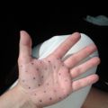Hyperhidros